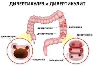 Дивертикулез толстой кишки