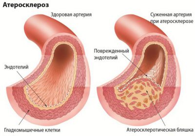 Атеросклероз