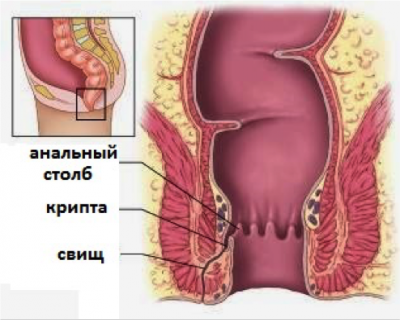 Парапроктит