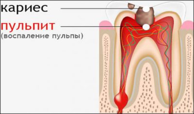 Пульпит