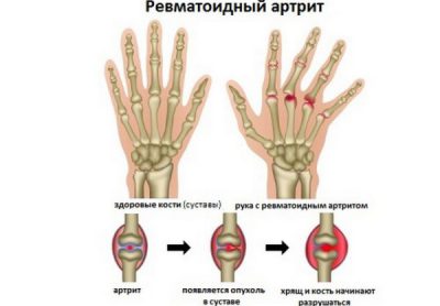 Ревматоидный артрит