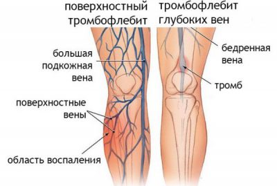 Тромбофлебит