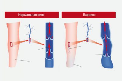 Варикозное расширение вен