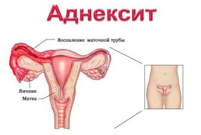 Аднексит