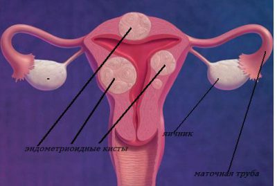 Киста яичника
