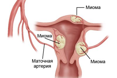 Миома матки