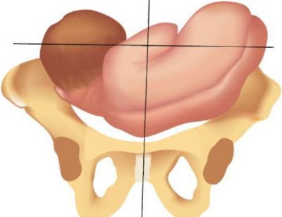 Неправильное положение плода