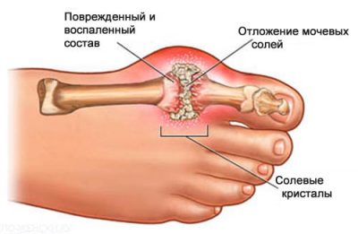 Подагра