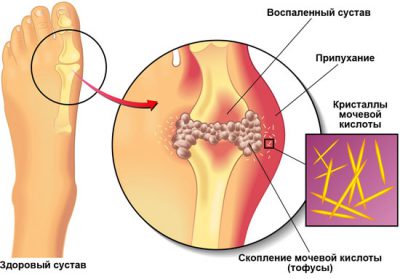 Подагра