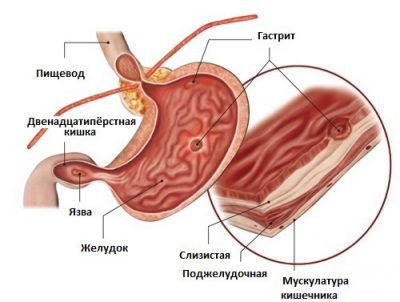 Повреждения слизистой желудка