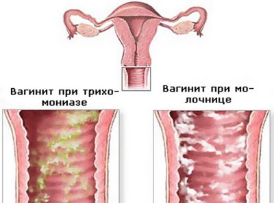 Вагинит кольпит