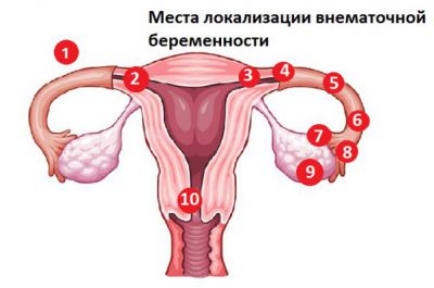 Внематочная беременность